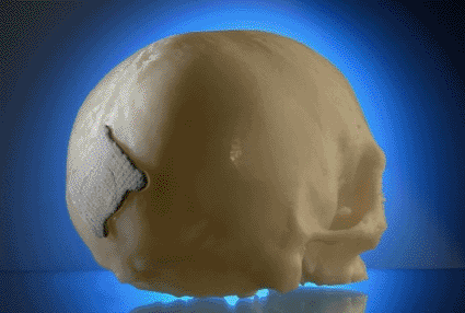 Image: A Degradable Cranial Implant fabricated using SLM Technology (photo courtesy Fraunhofer ILT).